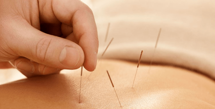 Acupuncture pour fumer
